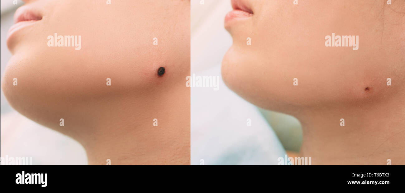 skin area ,before and after mole radio wave electrocoagulation removing. Part of series mole removing Stock Photo