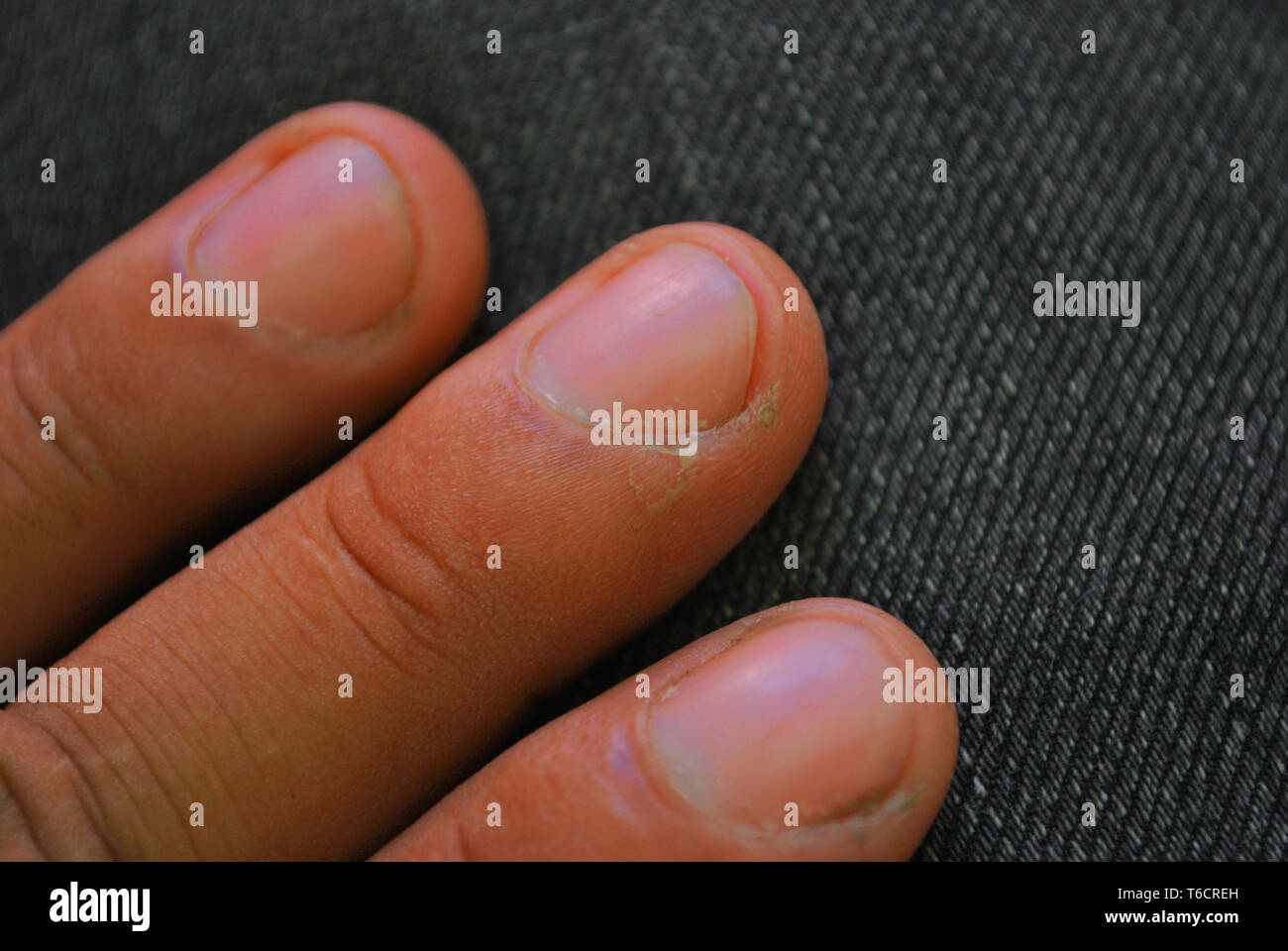 Dry skin peeling off Stock Photo Alamy