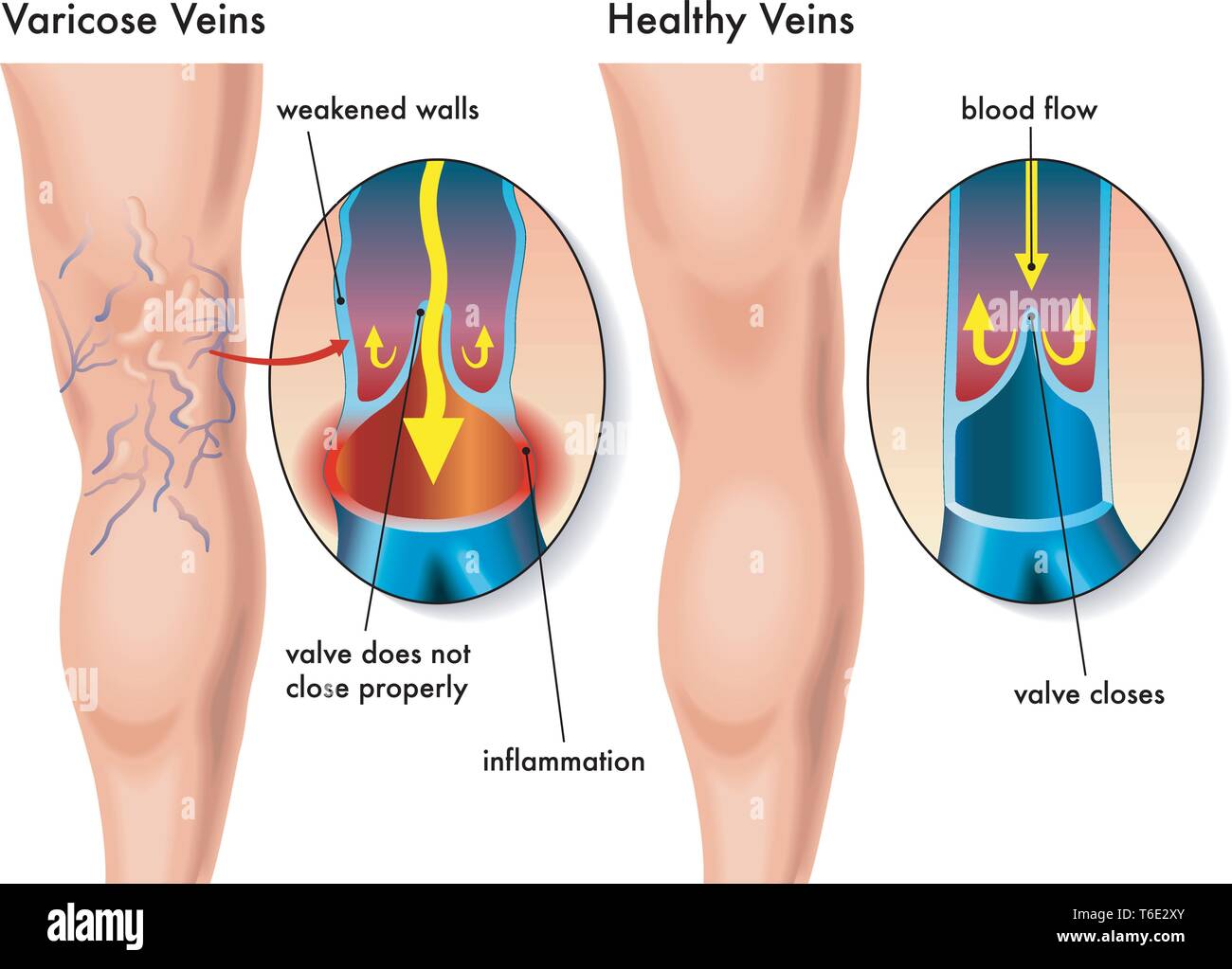 Medical illustration of the effects of the varicose veins Stock Vector