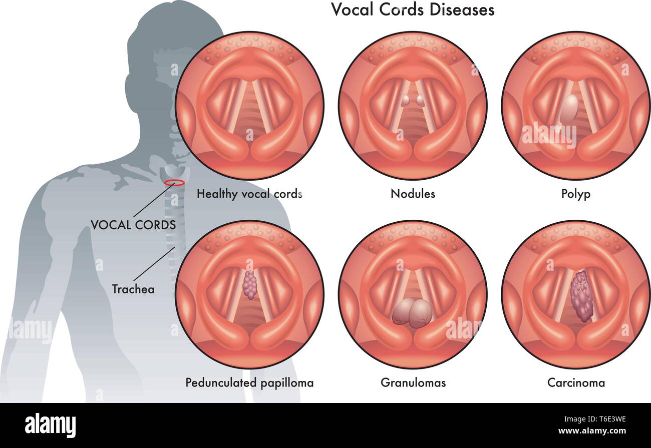 Medical illustration of the vocal cord diseases Stock Vector