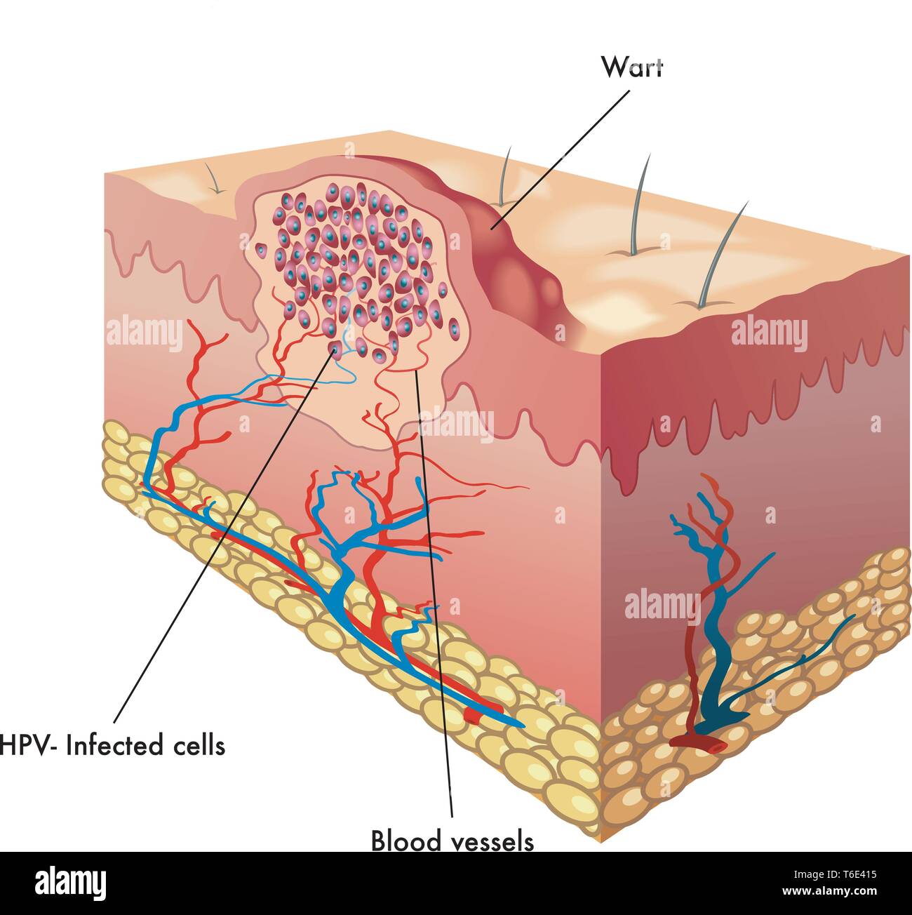 Medical illustration of a section of a wart Stock Vector