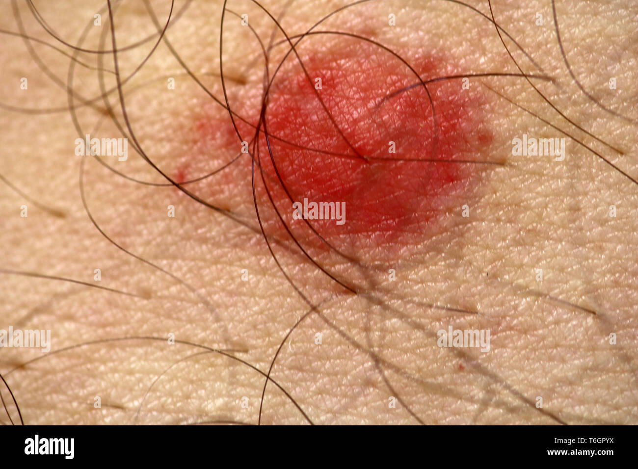 Insect bite hires stock photography and images Alamy