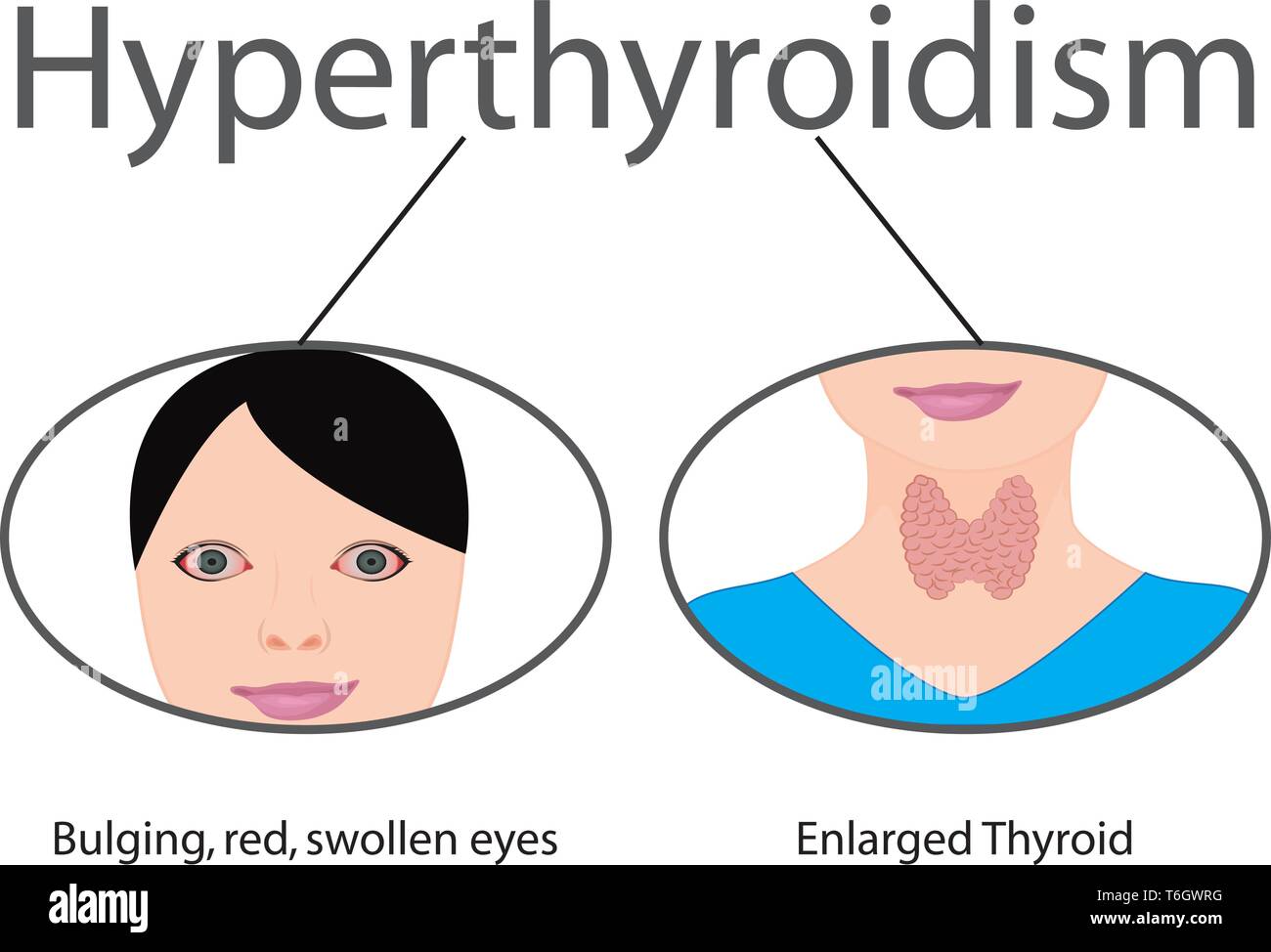 Hyperthyroidism. . Enlarged Thyroid. Endocrine disfunction vector illustration on a white background. Stock Vector