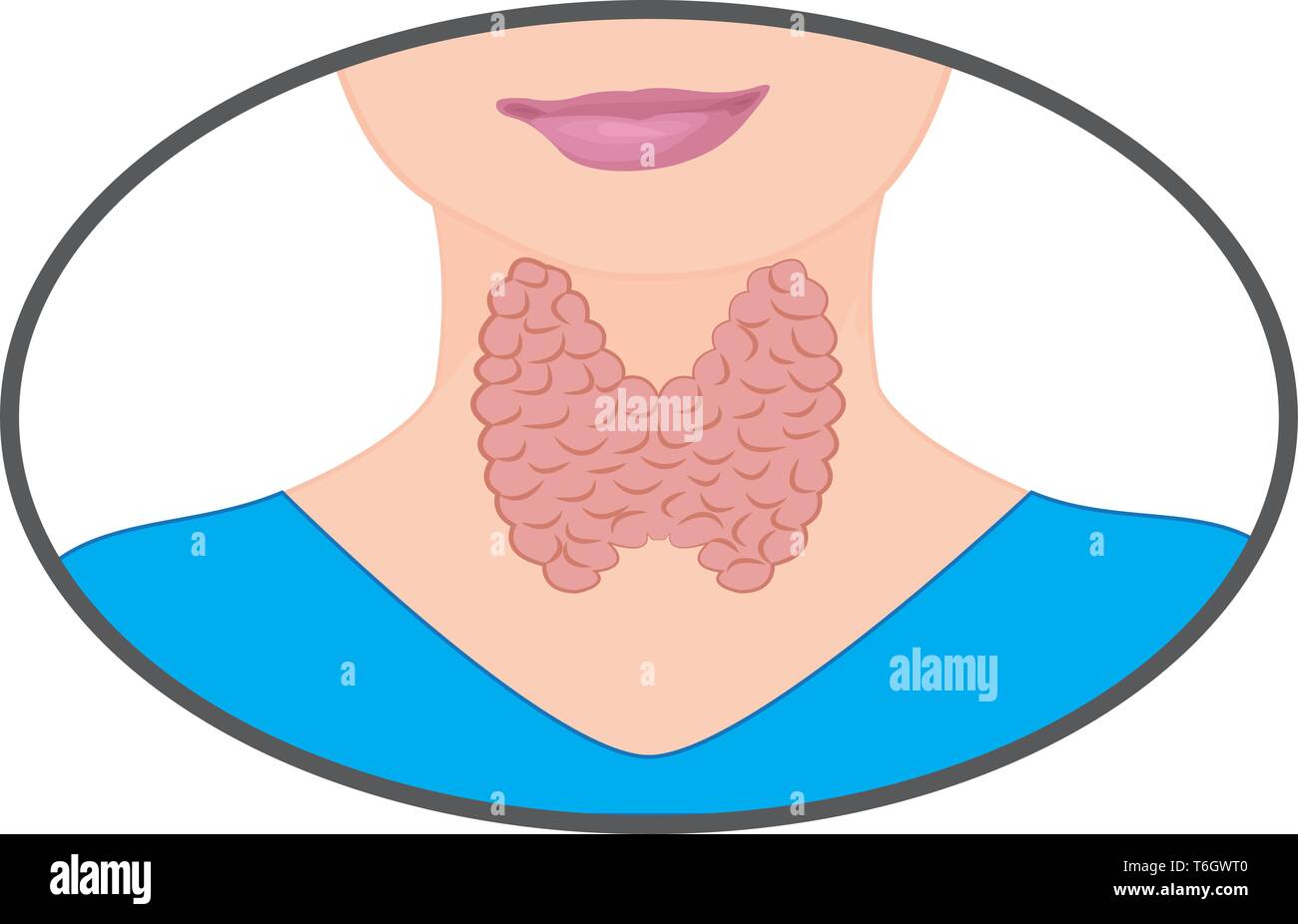 Goiter. Enlarged Thyroid. Endocrine disfunction vector illustration on a white background. Hyperthyroidism Stock Vector