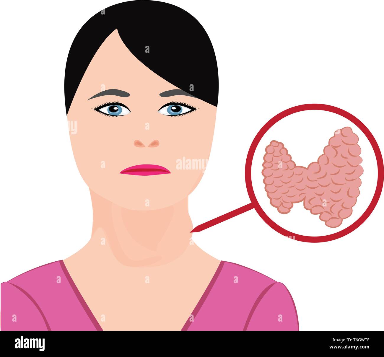 Goiter. Thyroid disease. Endocrine disfunction vector illustration on a white background. Hyperthyroidism Stock Vector