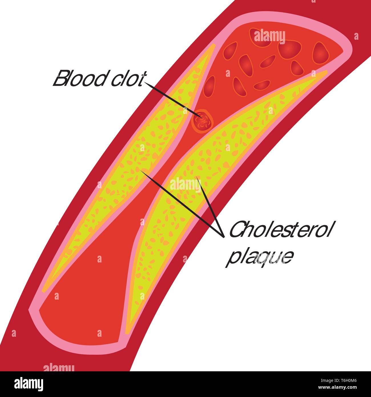 Blood clot and cholesterol plaque. Blocked blood vessel ...