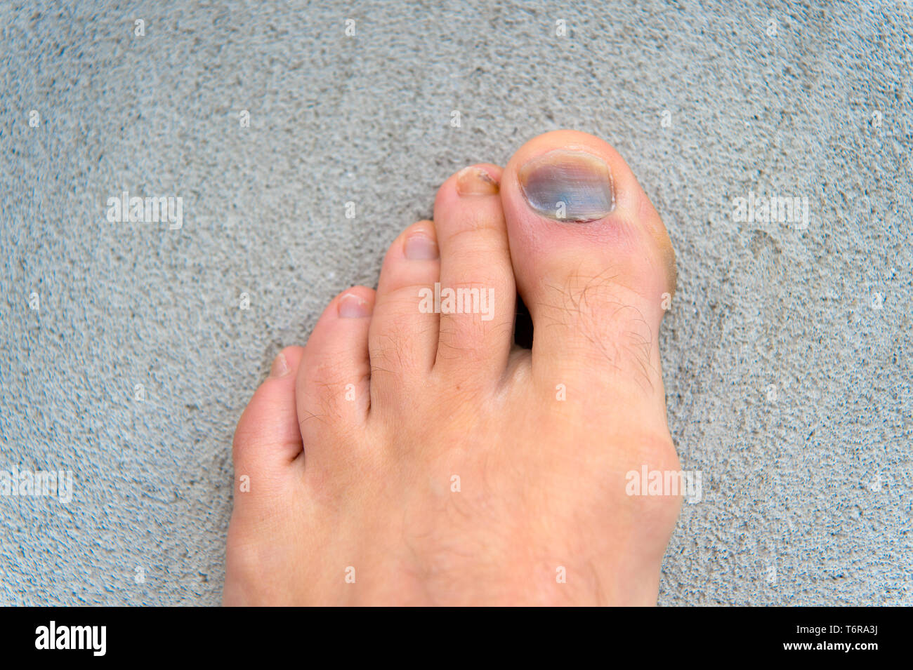 Broken Finger Nail Stock Photos & Broken Finger Nail Stock Images Alamy