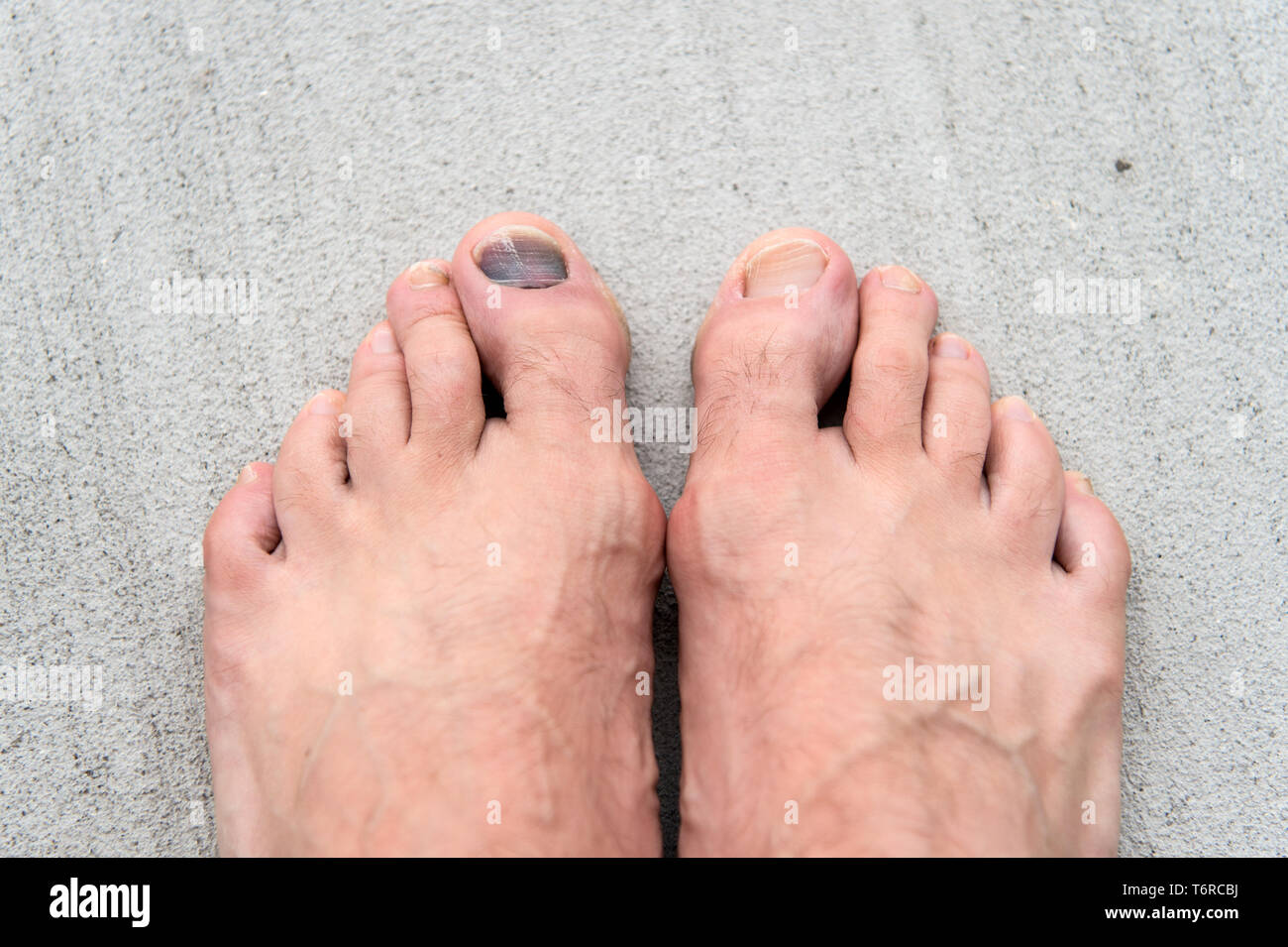 Take care of your feet. Pedicure and podiatry. Treatment of bruise and