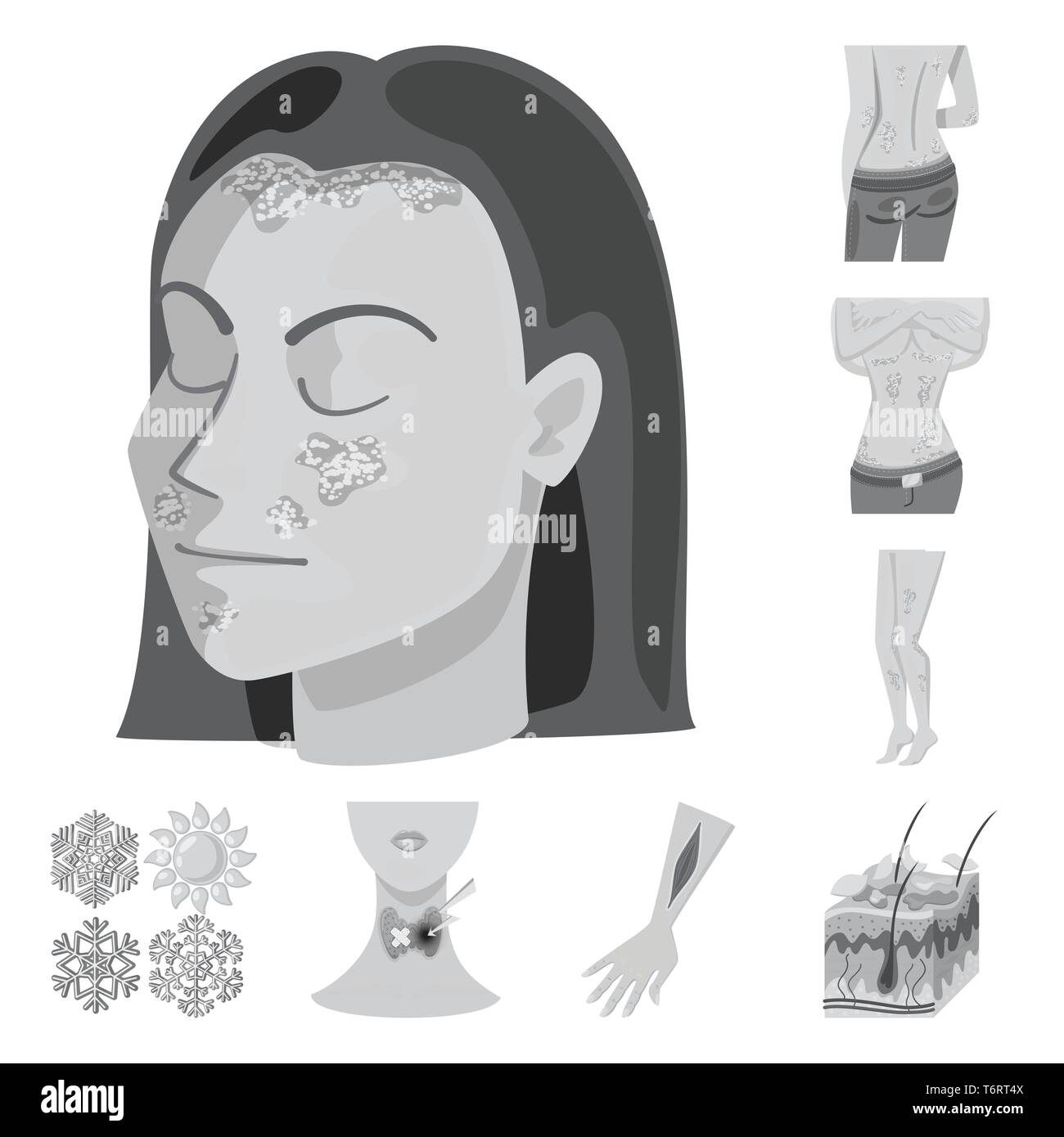 Psoriasis Snowflake Endocrine Injury Skin Body Falling System Arm Epidermis Rash Itchy Girl Allergy Frozen Thyroid Treatment Follicle Peeling Stomach Itch Sun Anatomy Hair Heat Wound Gland Head Back Chronic Legs Burn Human Medical Pain Dermatology