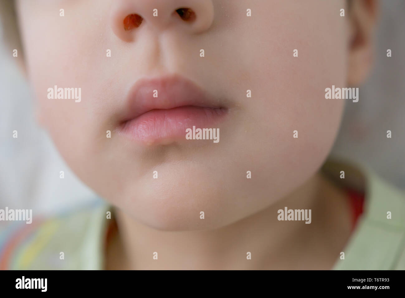 Swollen Cheek High Resolution Stock Photography and Images - Alamy Swollen Cheek High Resolution Stock Photography and Images - Alamy