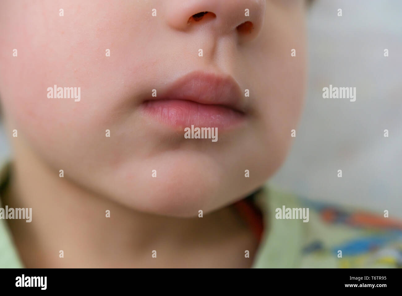 Swollen Cheek High Resolution Stock Photography and Images - Alamy Swollen Cheek High Resolution Stock Photography and Images - Alamy