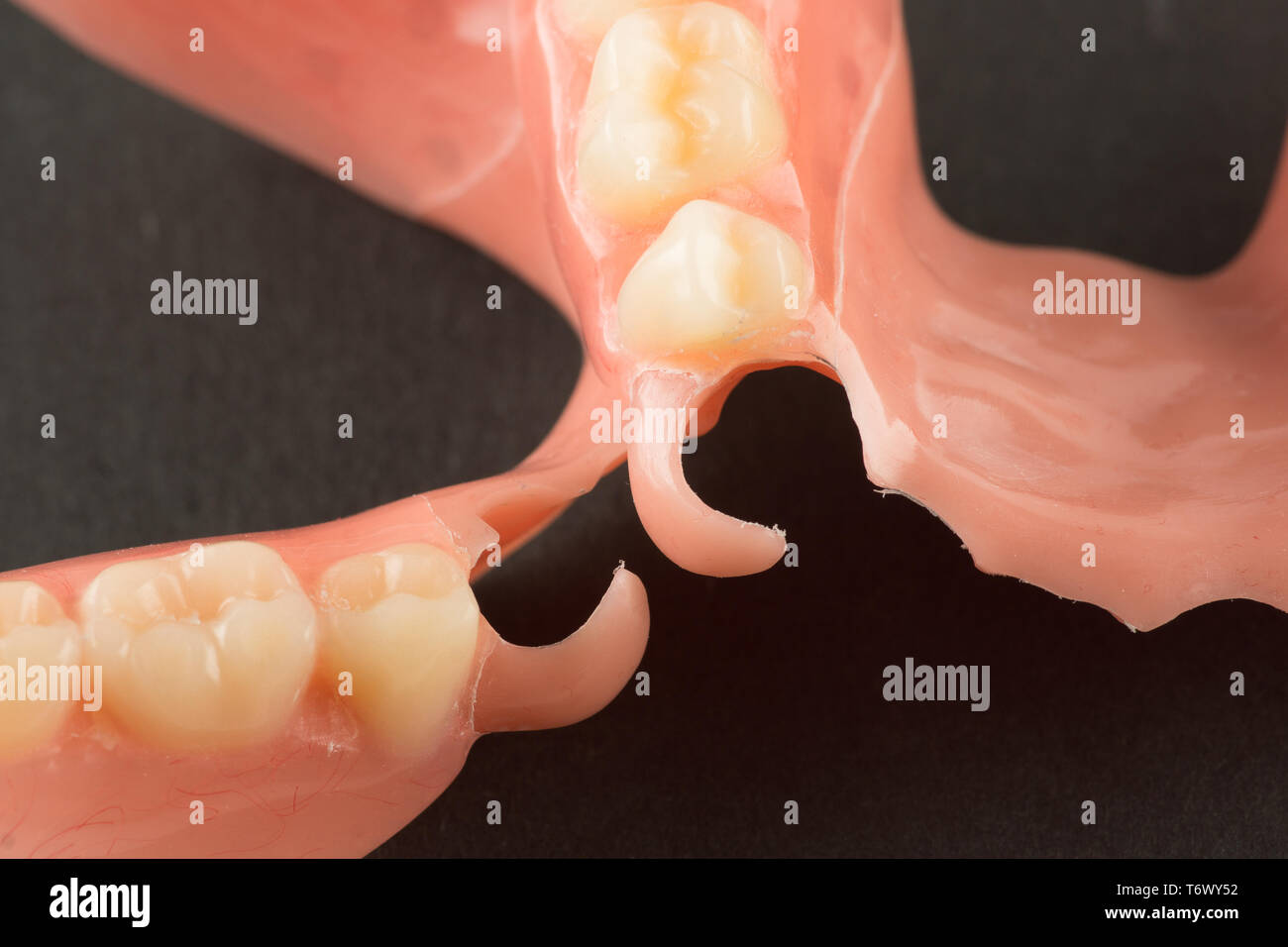 Импланты зубные премиум. Попадает пища под протезы. Мостовидные протезы. Постоянный протез all on 4. Элегантные импланты.