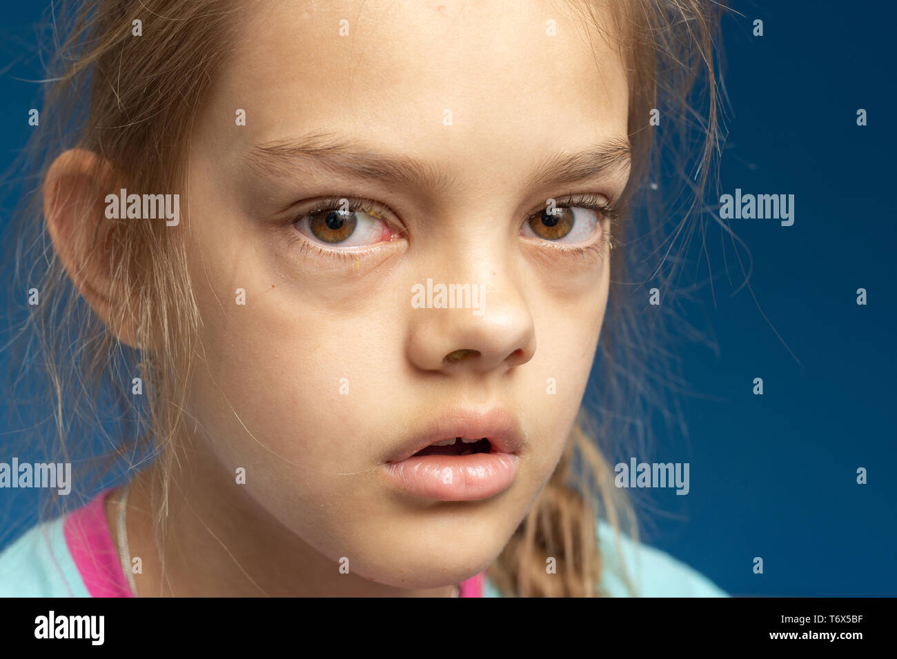 Conjunctivitis in front of a ten year old girl Stock Photo
