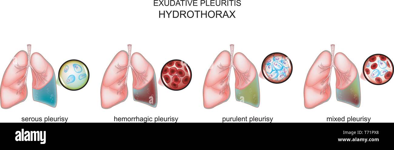vector illustration of the types of exudative pleurisy and hydrothorax. Stock Vector