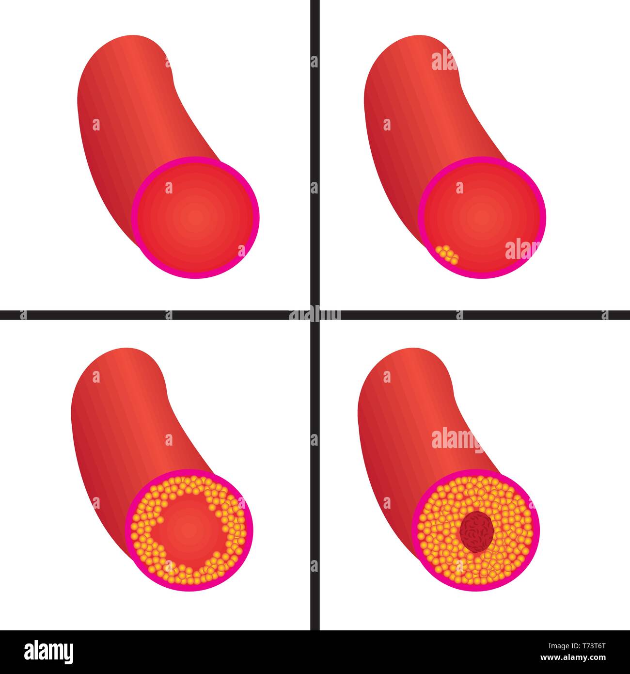 Levels of cholesterol plaque in vessels vector illustration Stock