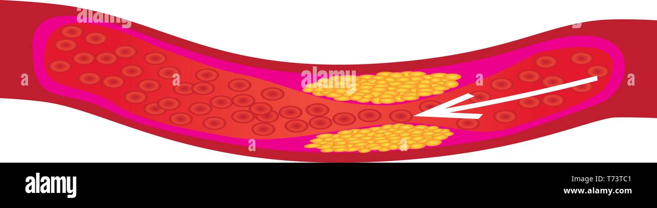 Levels of cholesterol plaque in vessels vector illustration Stock ...