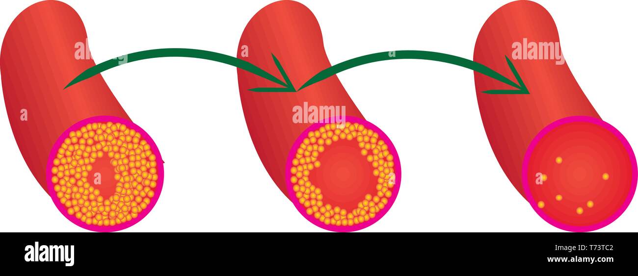 Reduce Levels of cholesterol plaque in vessels vector illustration ...