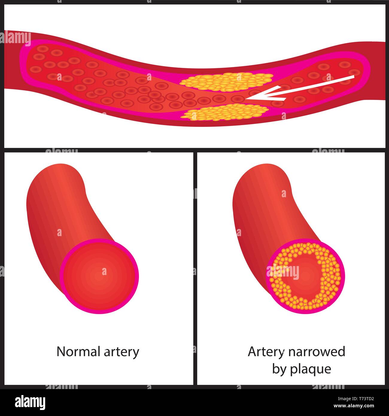 Levels of cholesterol plaque in vessels vector illustration Stock