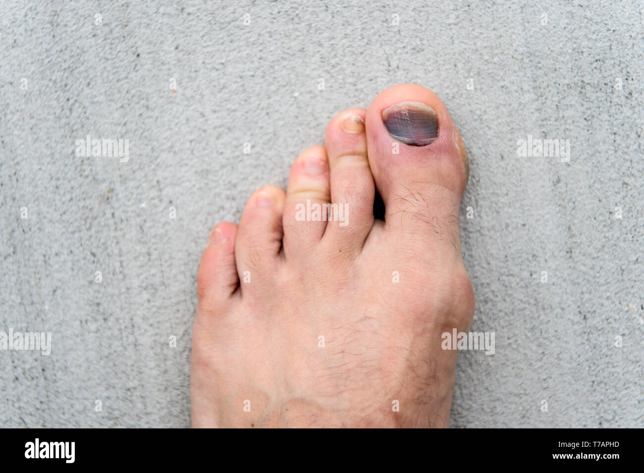 Closeup the ugly skin wound from ingrown toenail problem on woman toe nail  after self pedicure Stock Photo | Adobe Stock