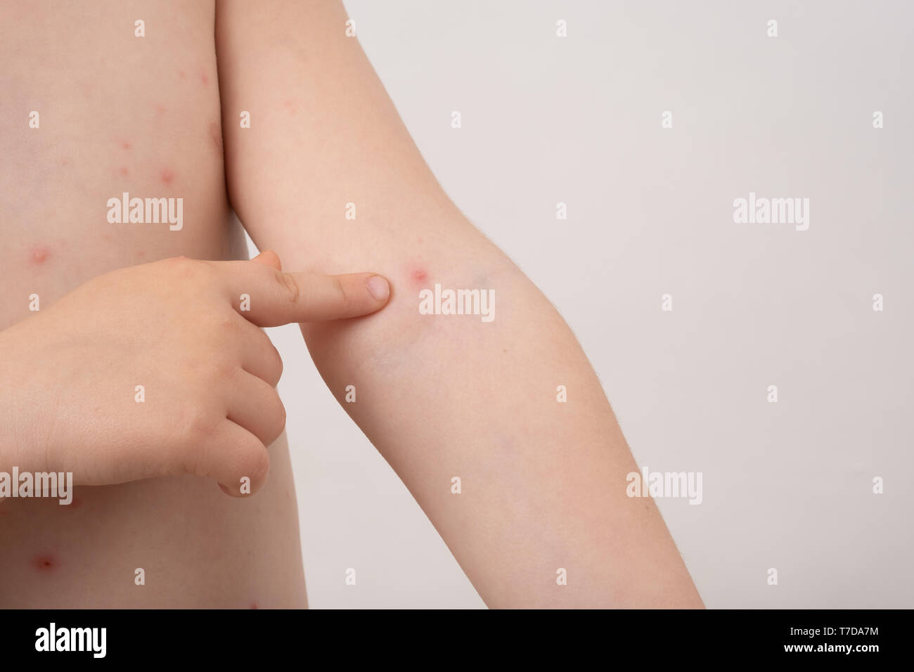 Baby with chicken pox rash. Varicella virus or Chickenpox bubble rash ...