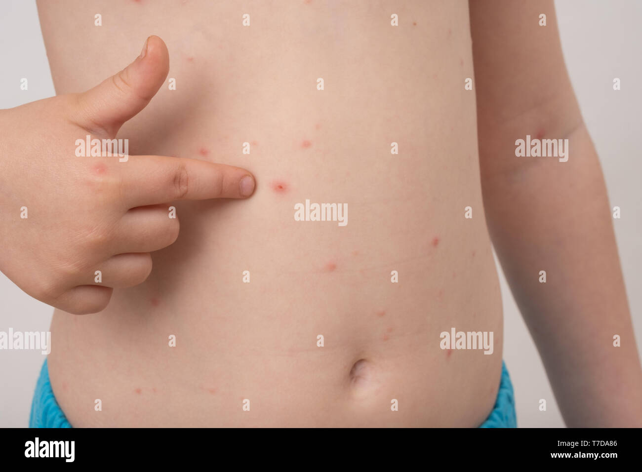 Baby With Chicken Pox Rash Varicella Virus Or Chickenpox Bubble Rash On Child Dermatology Concept Toddler Shows Blemishes On His Belly Stock Photo Alamy