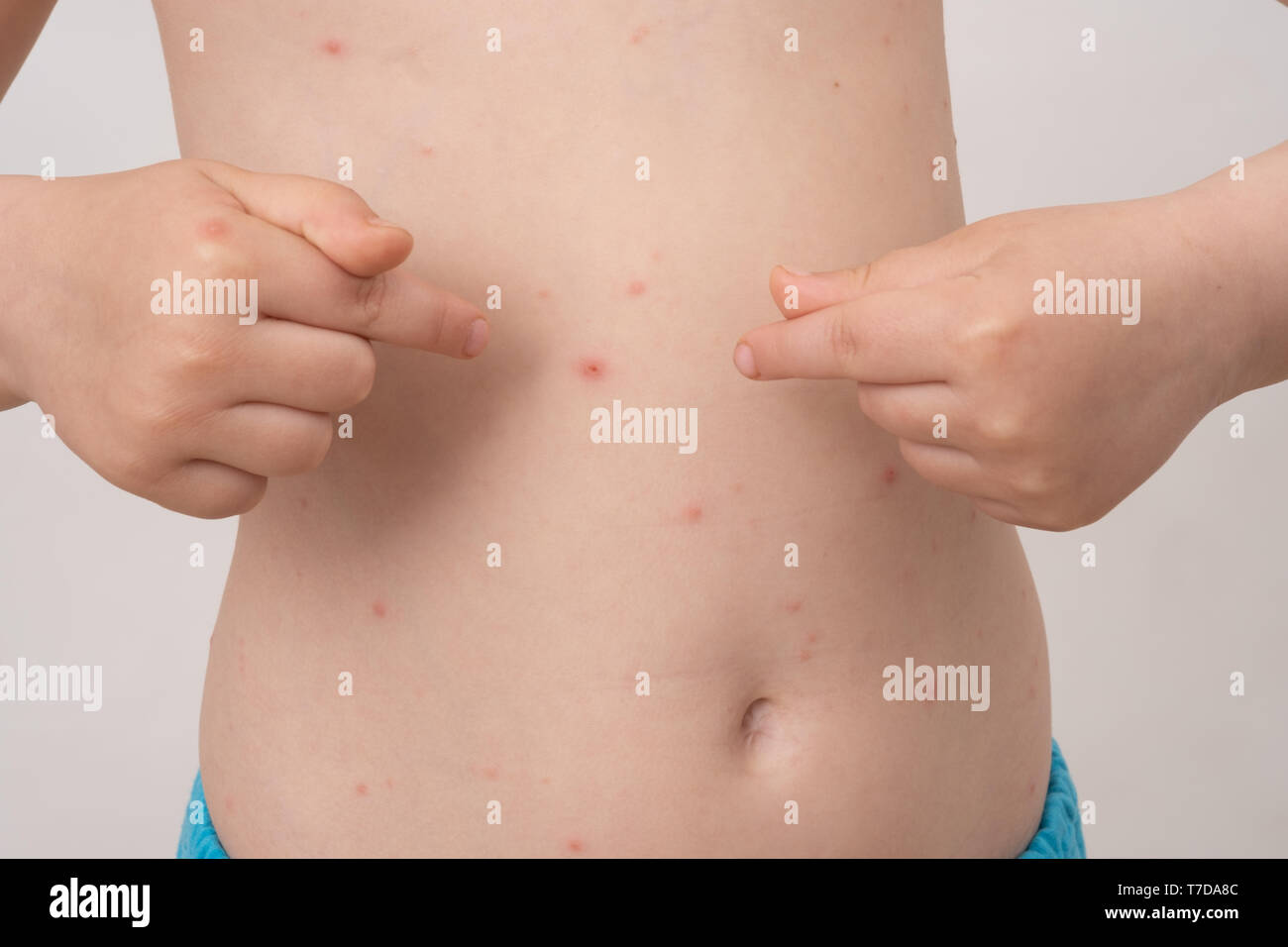 Baby With Chicken Pox Rash Varicella Virus Or Chickenpox Bubble Rash On Child Dermatology Concept Toddler Shows Blemishes On His Belly Stock Photo Alamy