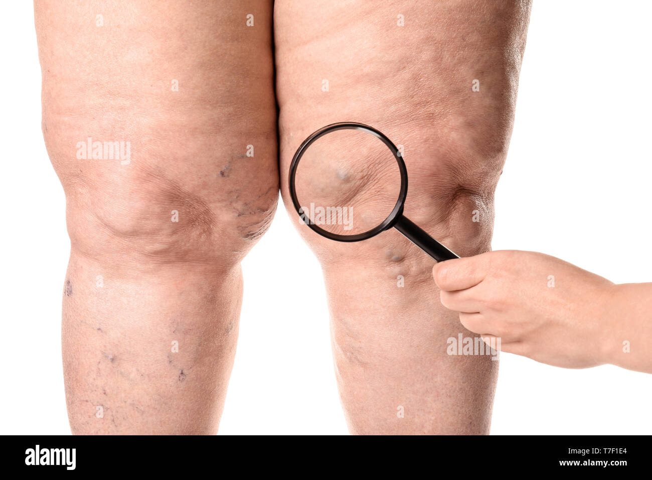 View of varicose veins on woman's leg through magnifying glass on white background, closeup Stock Photo