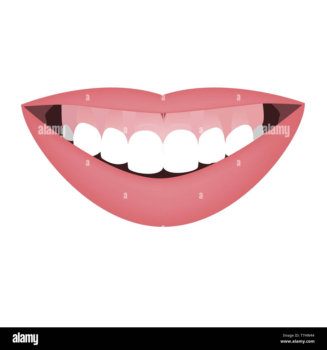 Mouth with a distal bite and high smile line or gummy smile before the orthotropics or orthotropics treatment. Vector illustration Stock Vector
