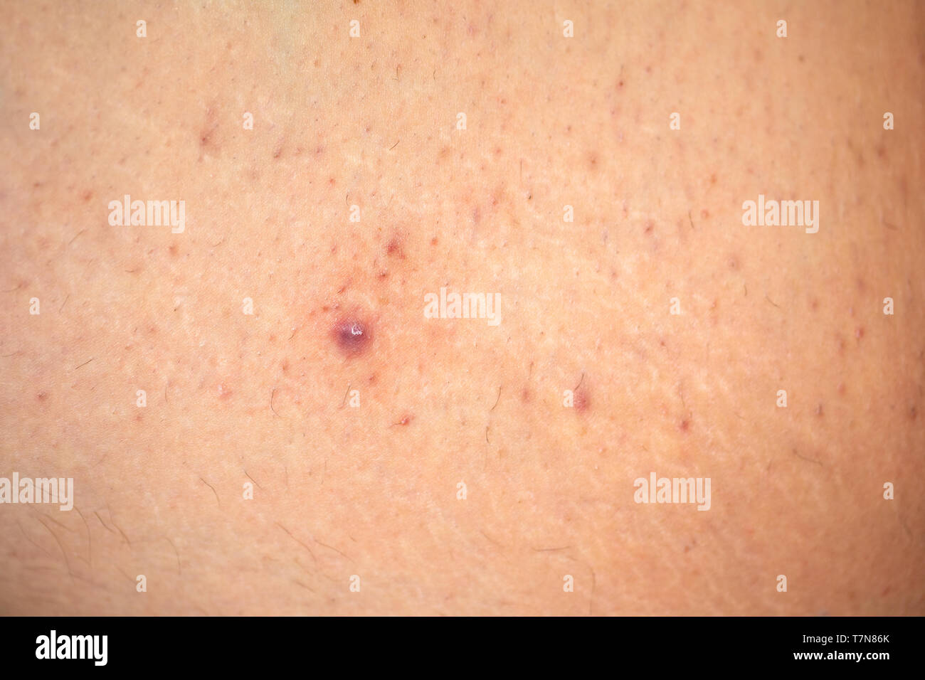 Close up picture of painful folliculitis on female leg. Shaving, infected follicle