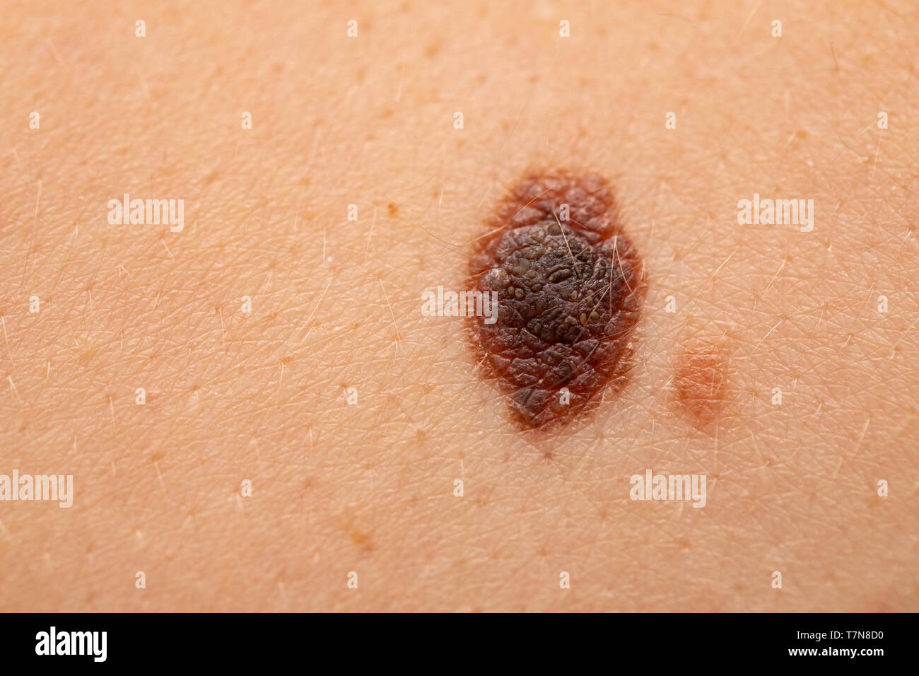 Close up picture of dangerous brown nevus on human skin - melanoma Stock Photo