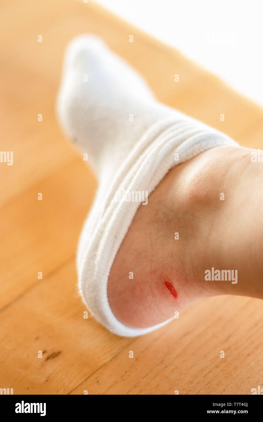 Sore from blister on heel Stock Photo