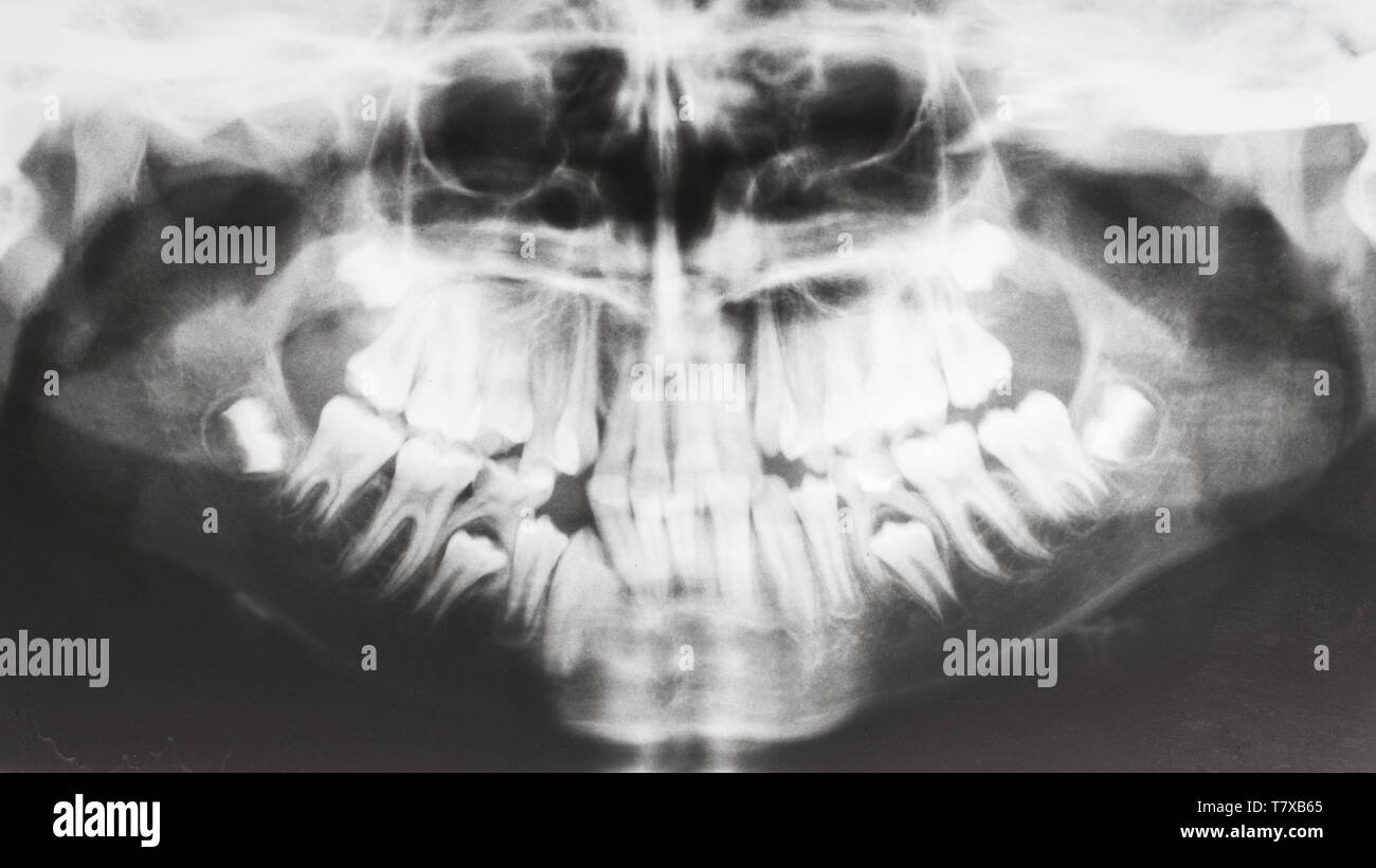 front view of human jaws on Xray image Stock Photo Alamy