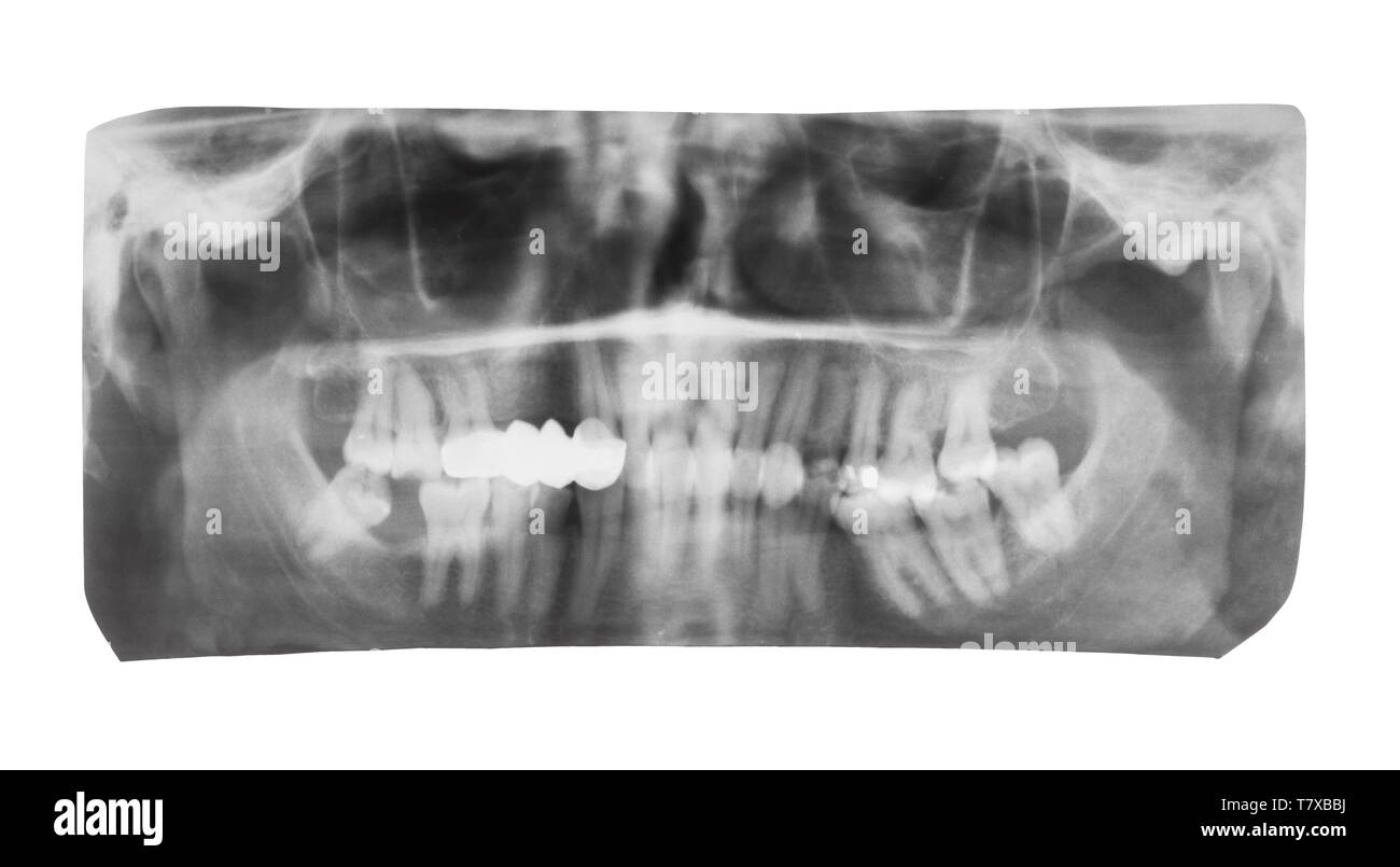Jaw x ray Cut Out Stock Images & Pictures Alamy