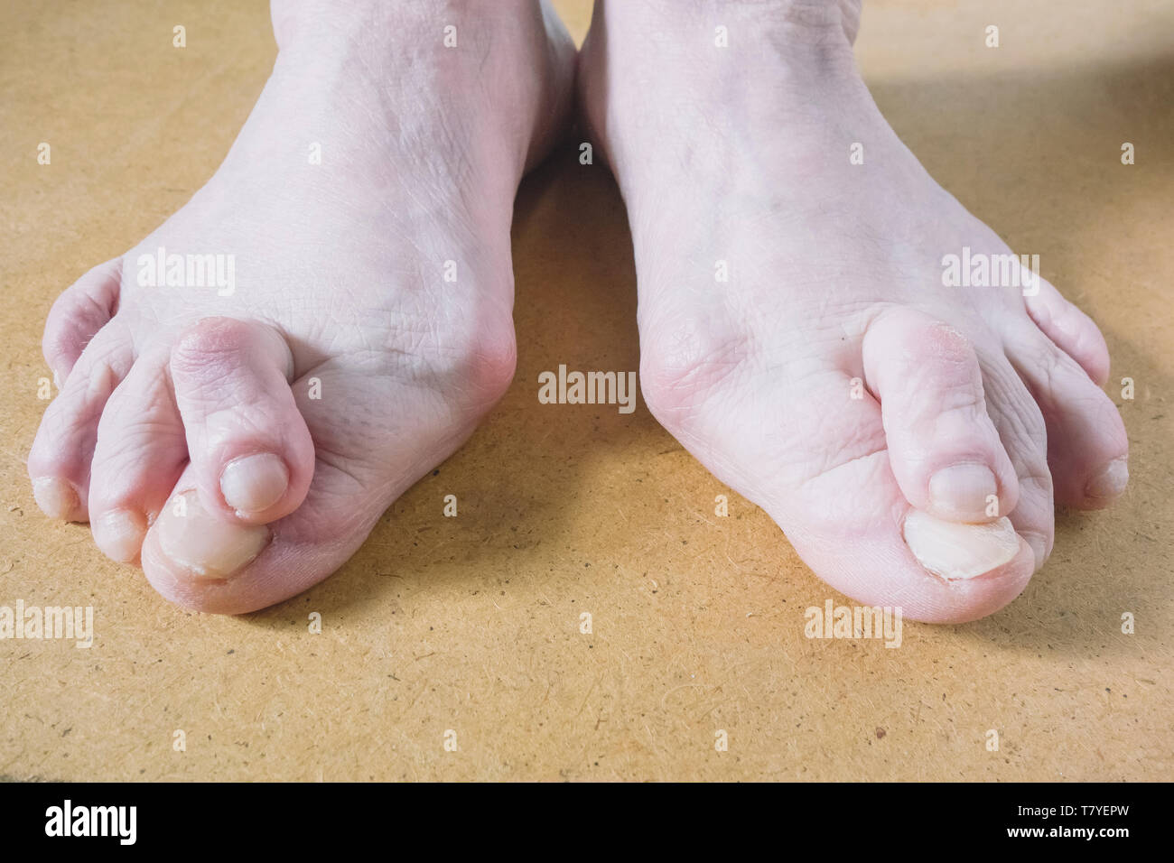 Valgus Deformity of Female Leg Due Hallux Valgus and Weakness of Ligaments. Stock Photo