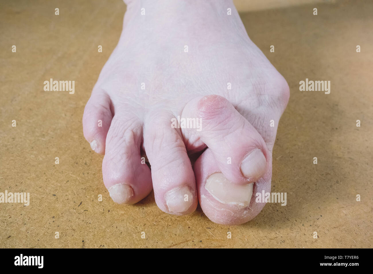 Valgus Deformity of Female Leg Due Hallux Valgus and Weakness of Ligaments. Stock Photo