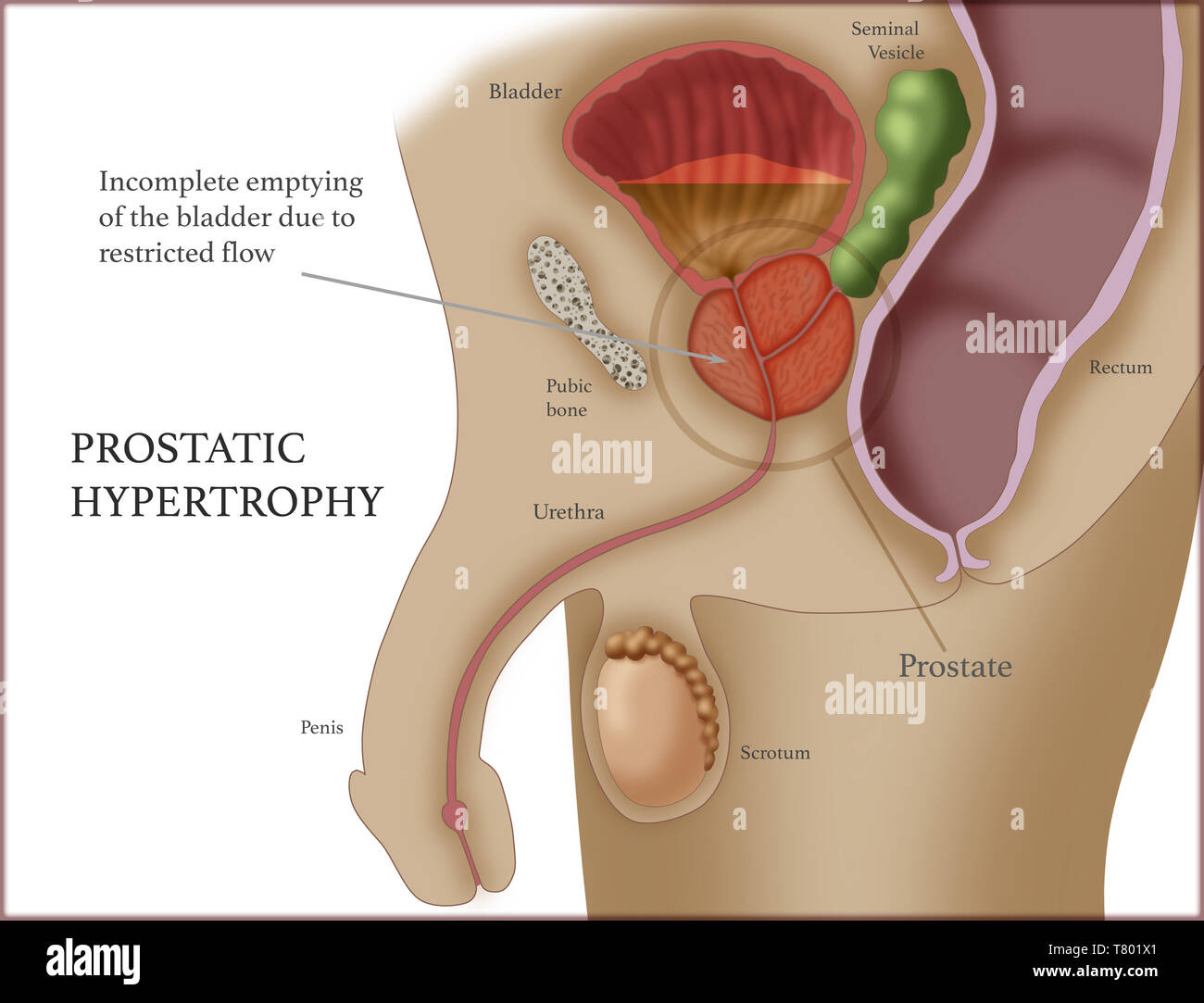 how to reduce prostate enlargement naturally