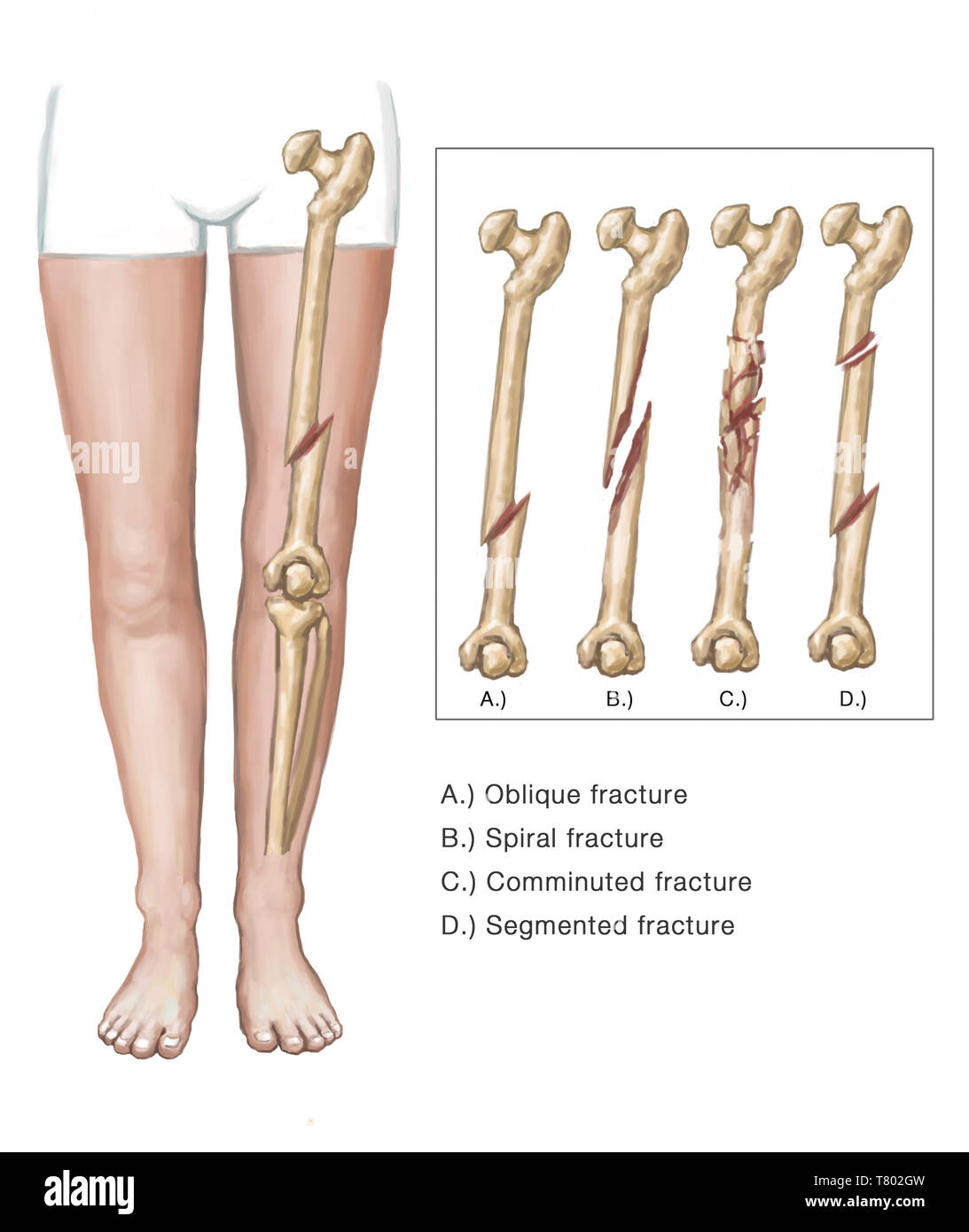 Broken Leg, Illustration Stock Photo