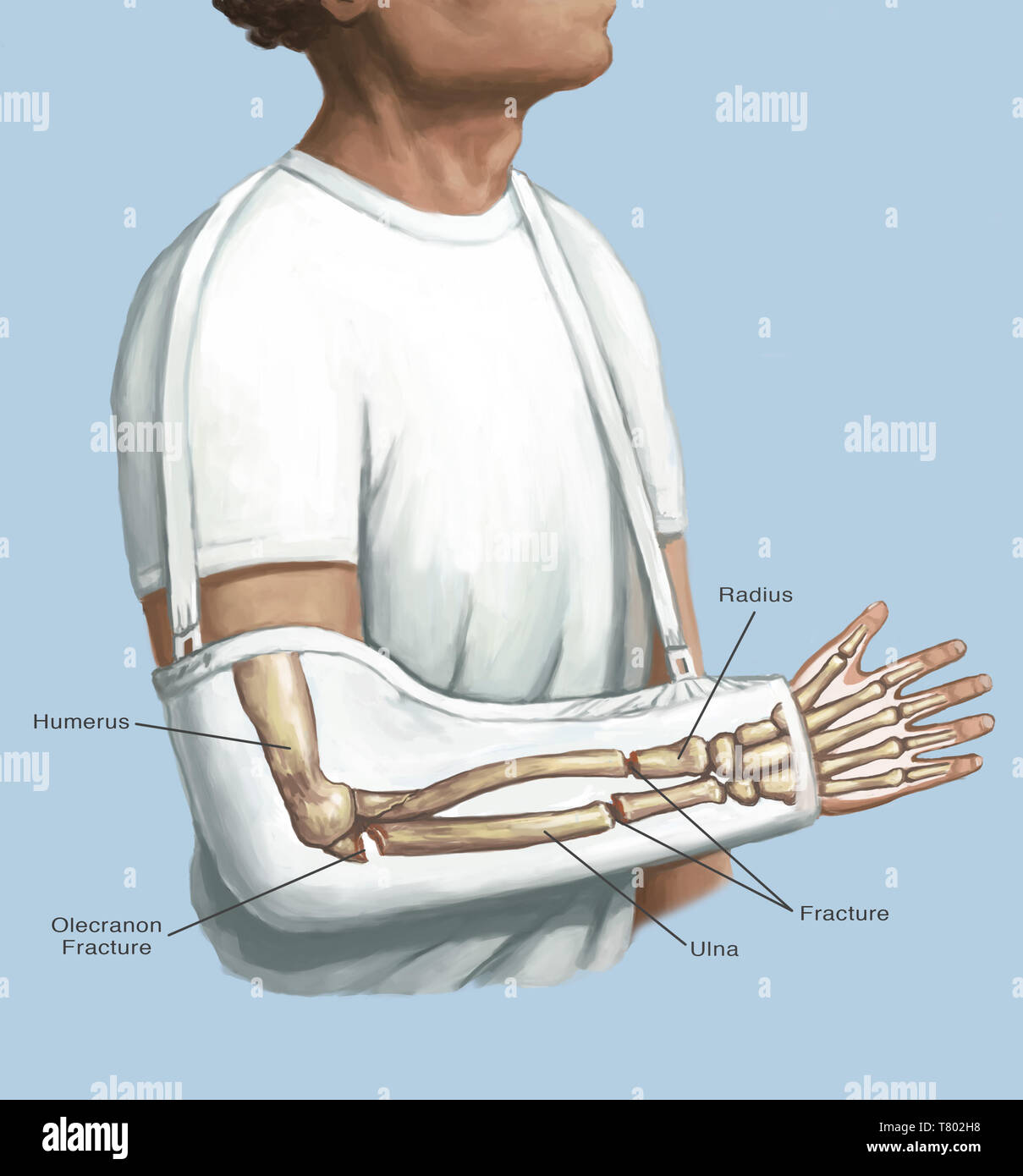 Arm cast and drawing hires stock photography and images Alamy
