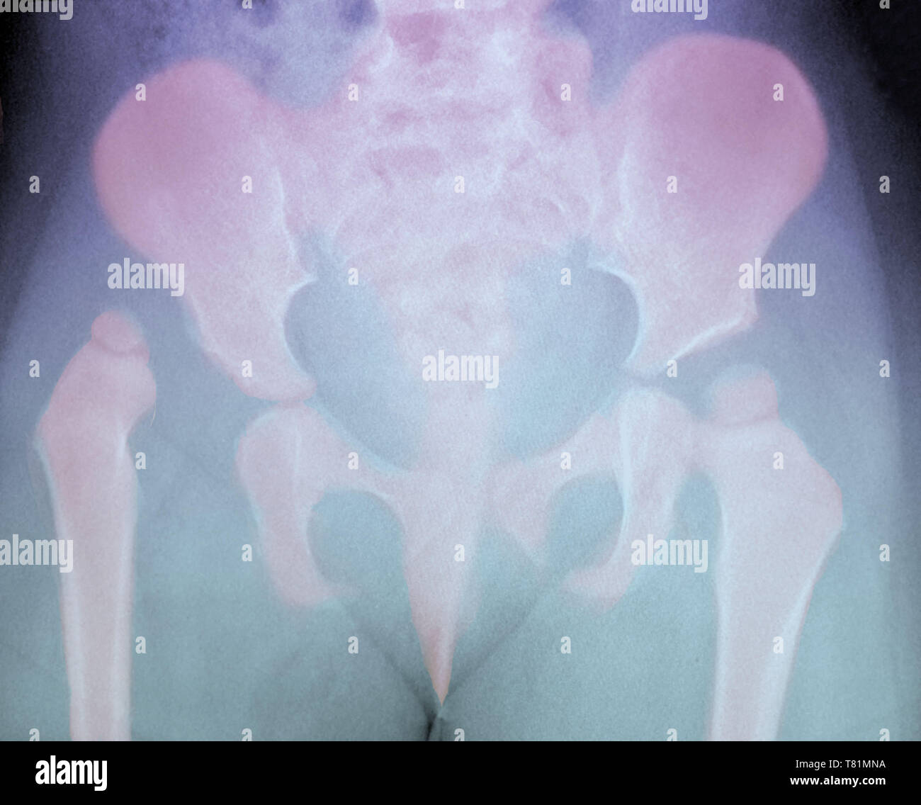 Hip Dysplasia in Child, X-Ray Stock Photo