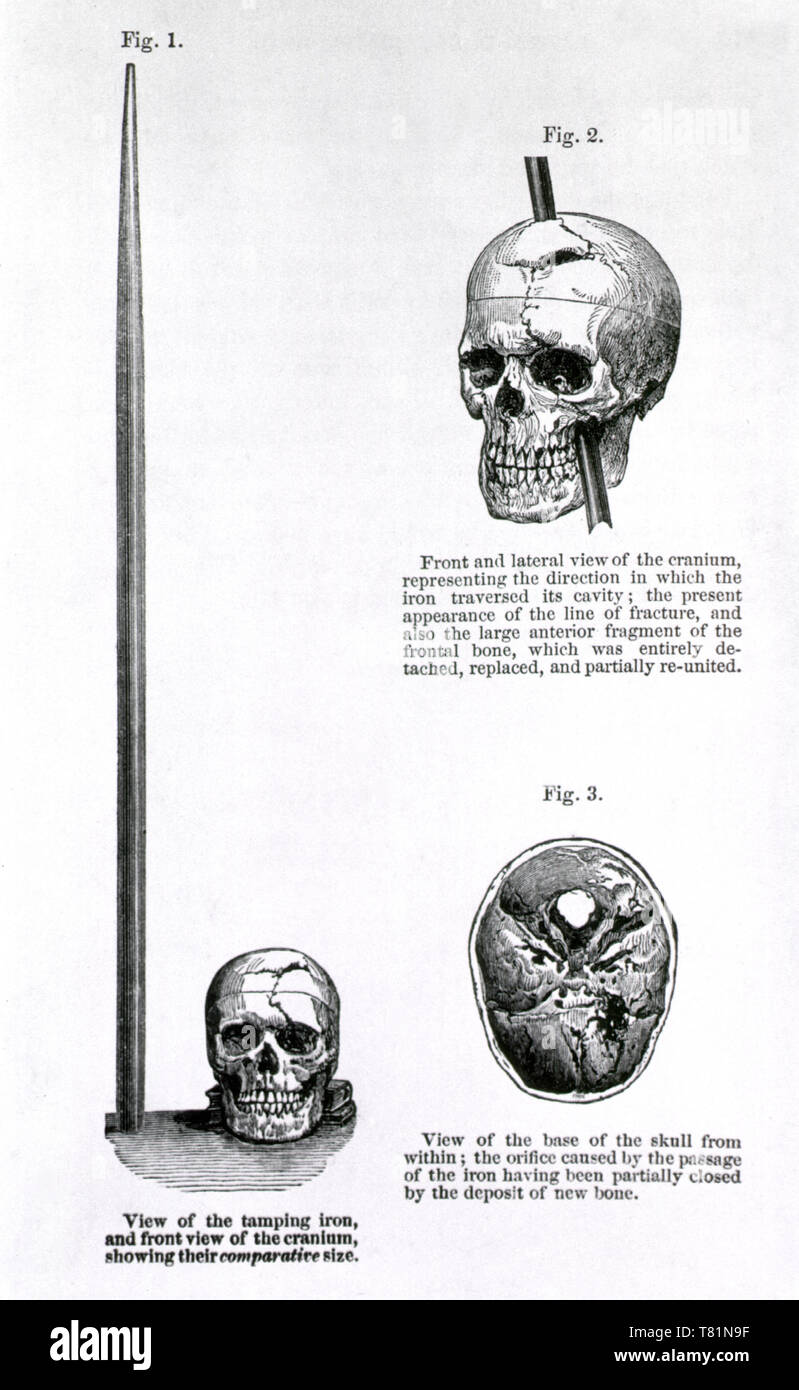 Phineas Gage Hi res Stock Photography And Images Alamy