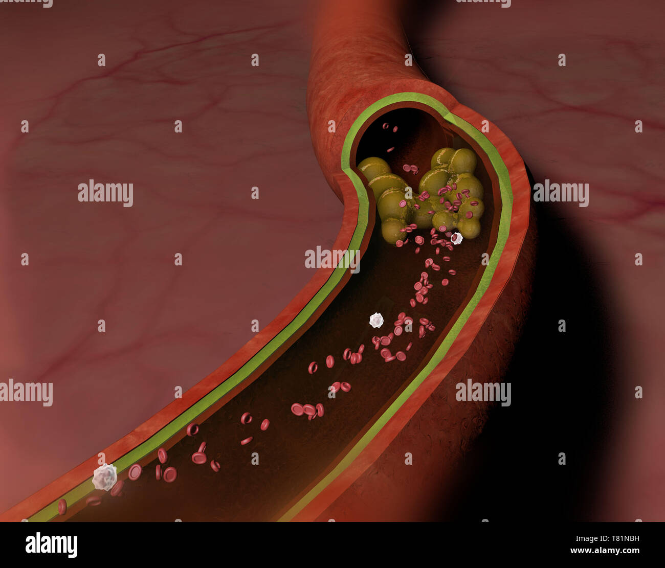 Clogged Artery, Illustration Stock Photo