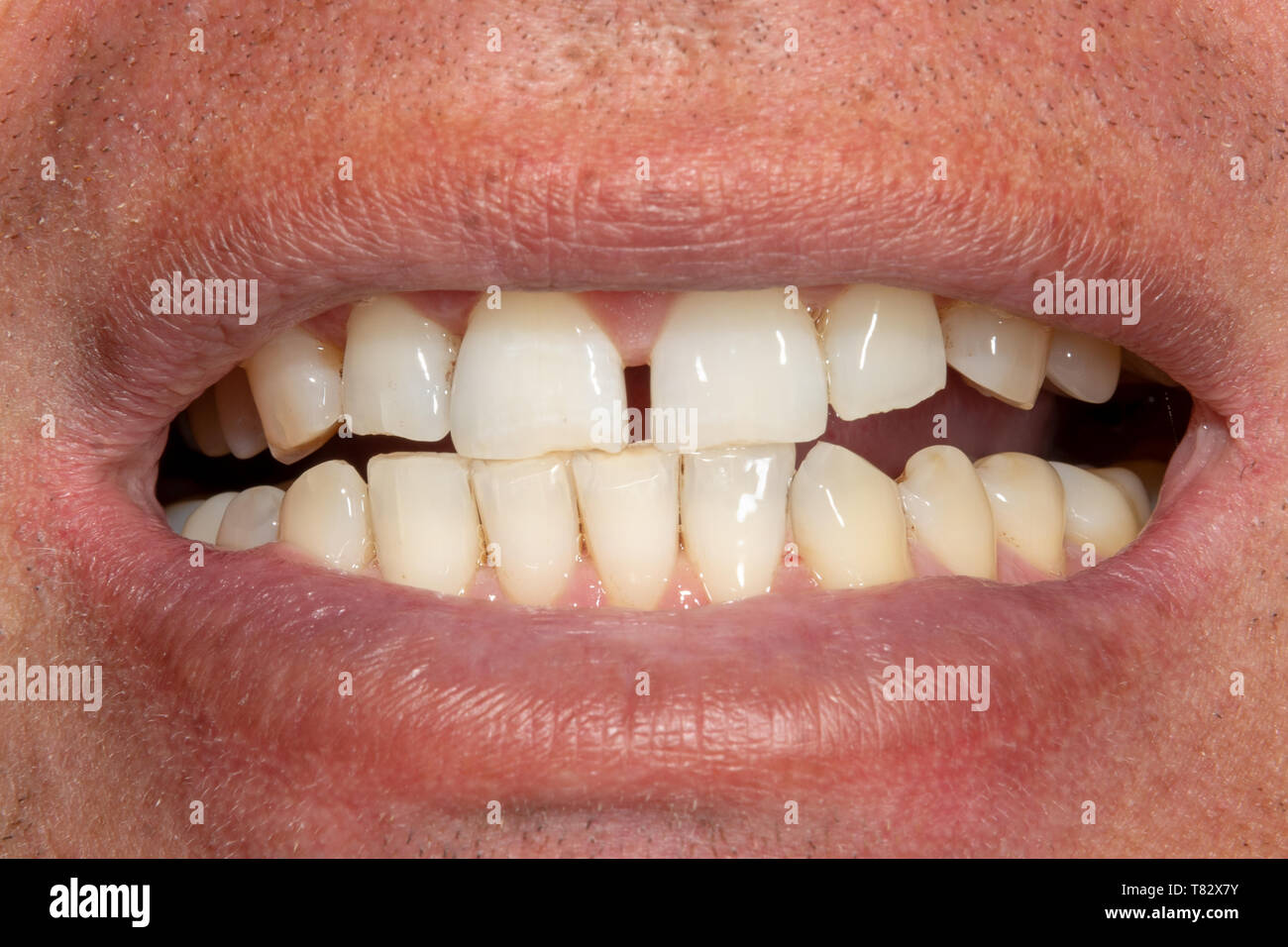 the teeth close-up after hygiene and bleaching. Man's face and smile Stock Photo