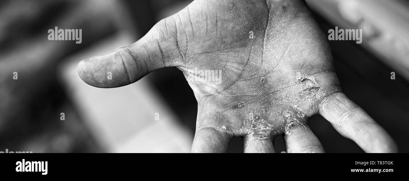 Callus finger hires stock photography and images Alamy