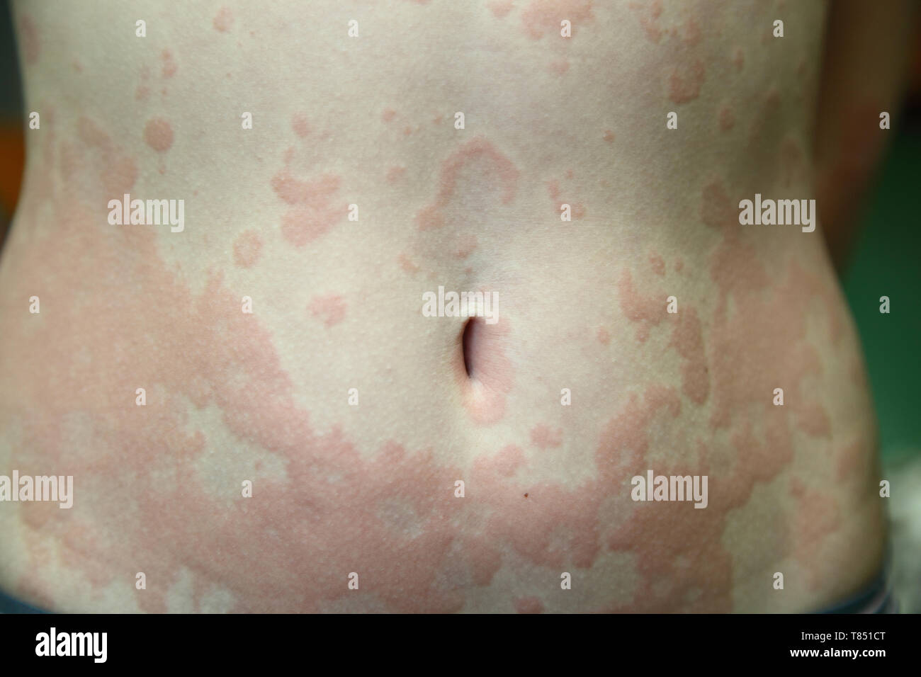 allergic dermatitis. The skin of the girl is amazed by dermatitis Stock Photo