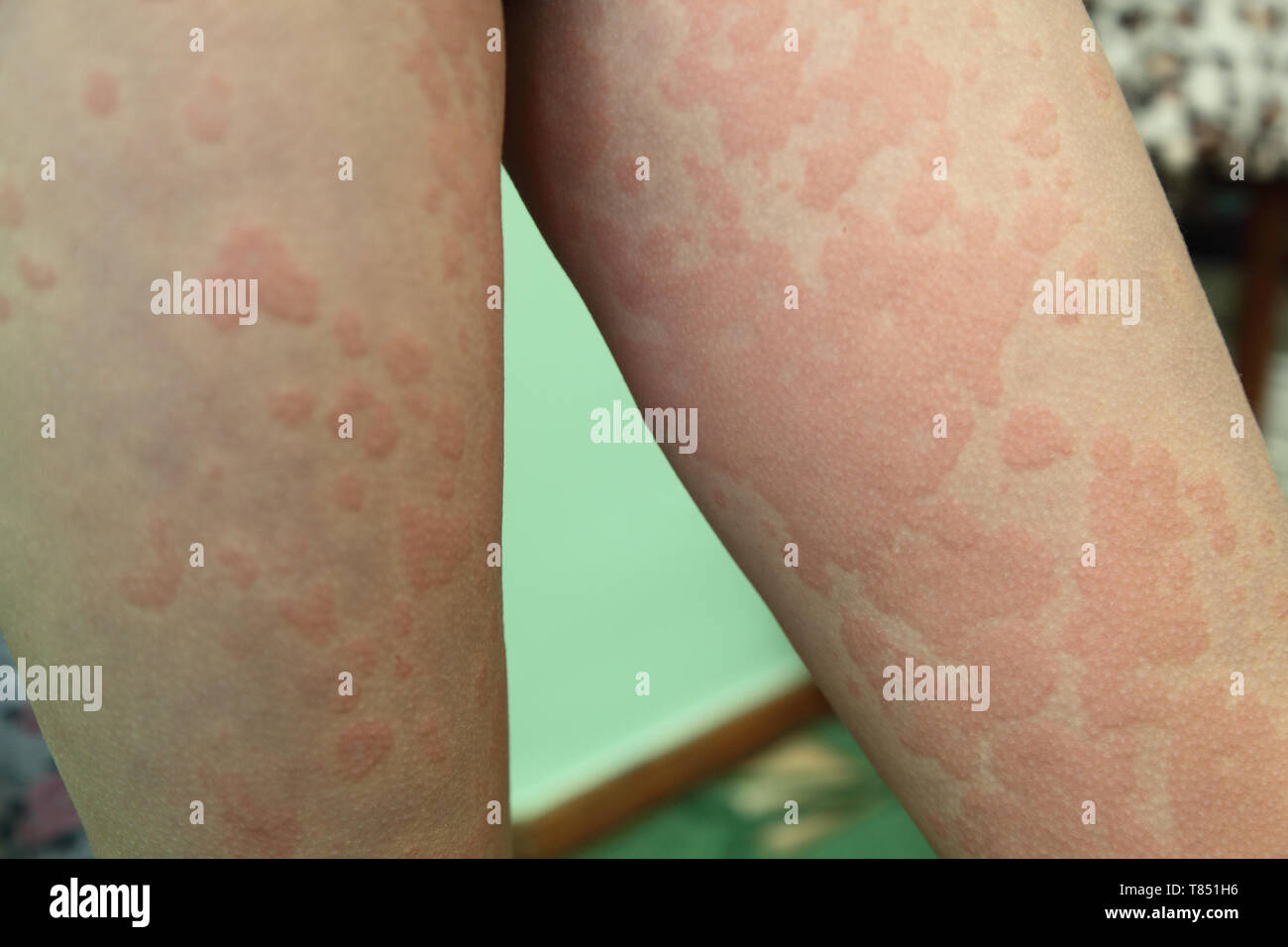 Allergic rash dermatitis skin texture hires stock photography and