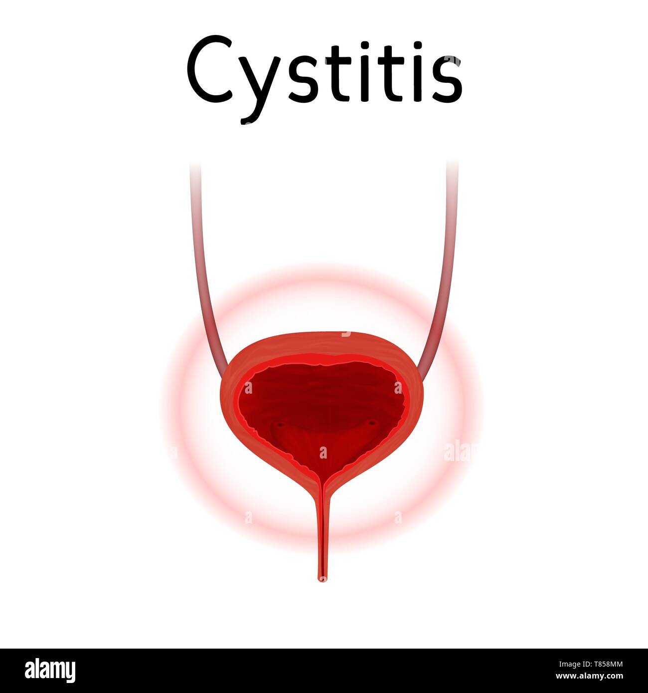Cystitis, illustration Stock Photo