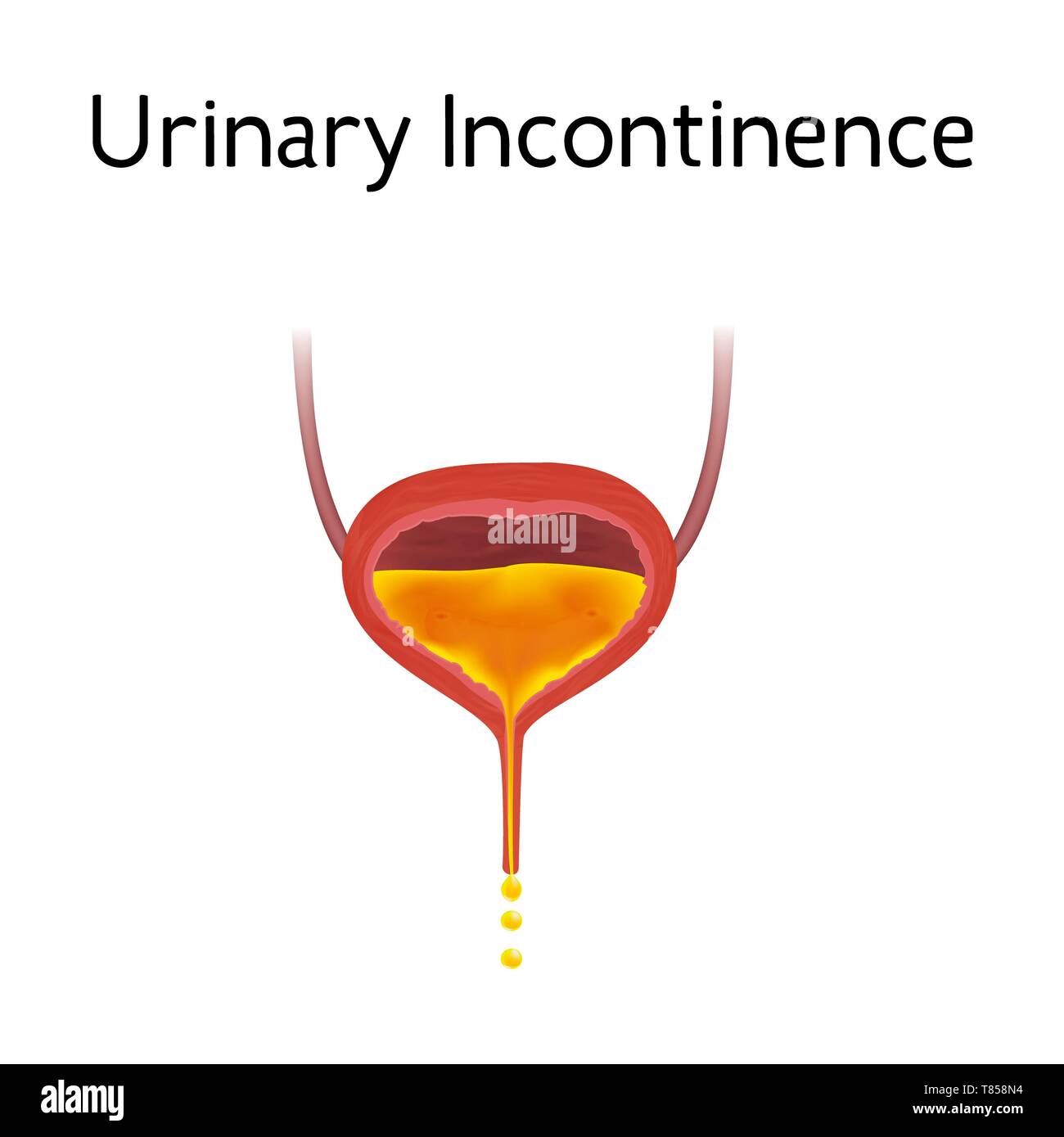 Urinary incontinence, illustration Stock Photo - Alamy