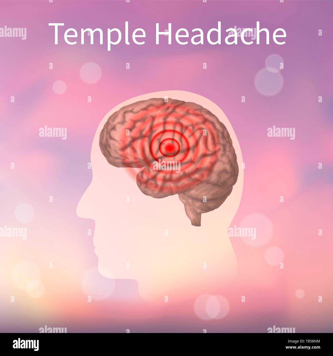 Temple headache, illustration Stock Photo Alamy