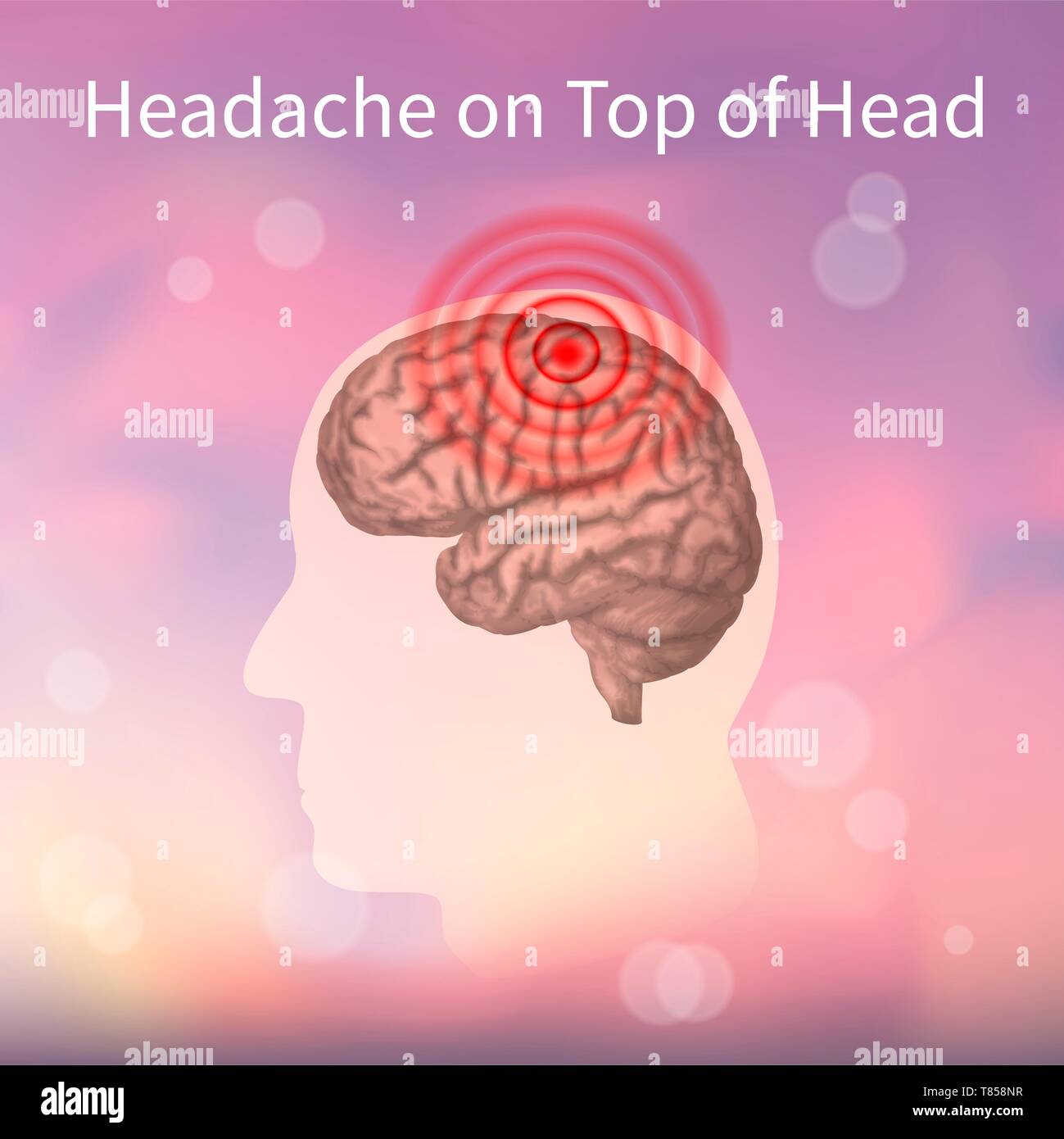 Headache on top of the head, illustration Stock Photo - Alamy