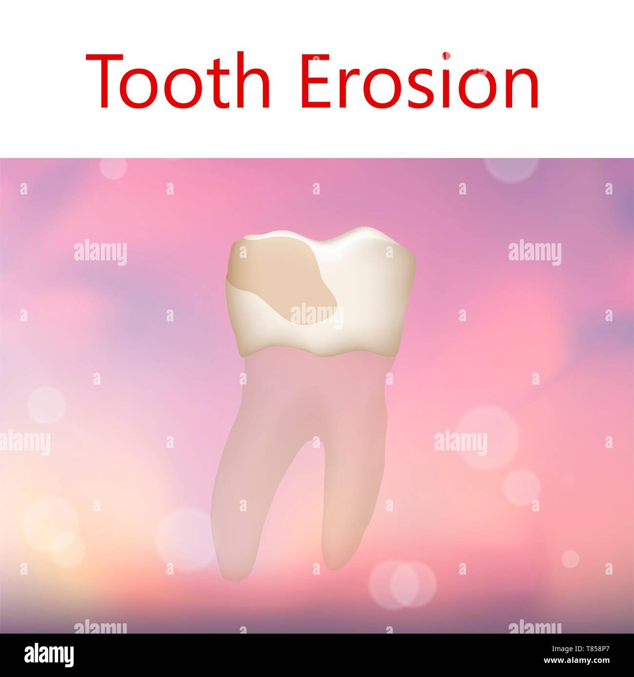 Tooth Erosion Symptoms